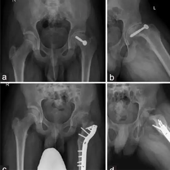 x-ray pelvis both hip ap and lat